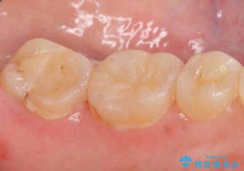 セラミックインレー 虫歯治療の治療後