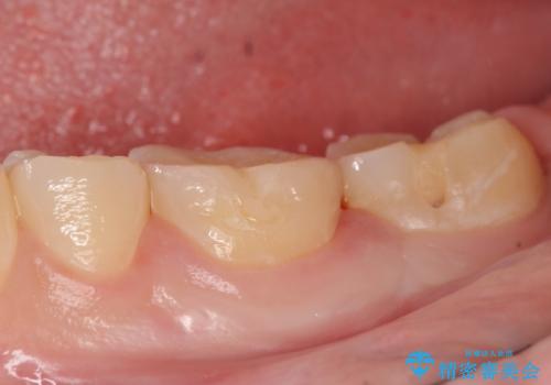 セラミックインレー 虫歯治療の治療後