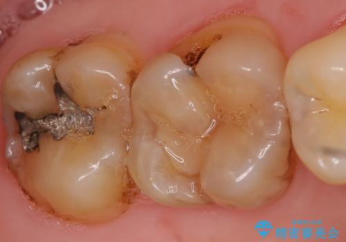 セラミックインレー 古い銀歯のやり替えの治療前