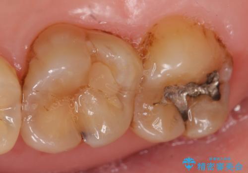 セラミックインレー 古い銀歯のやり替えの治療前