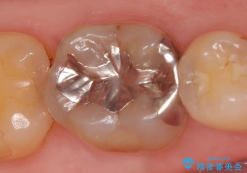 セラミックインレー 銀歯を白くの治療前
