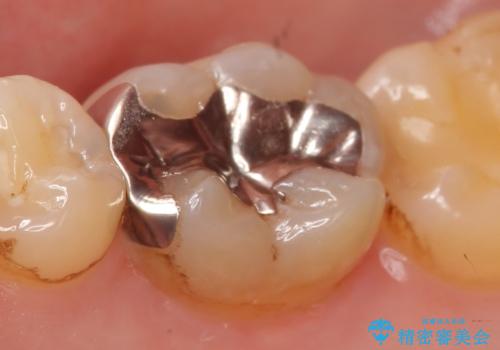 セラミックインレー 銀歯を白くの治療前