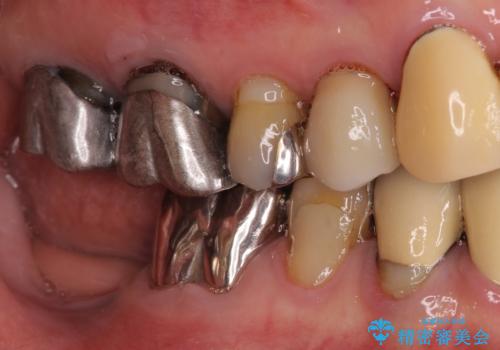 小臼歯の審美治療　ストローマンインプラントとカスタムアバットメントの症例 治療前