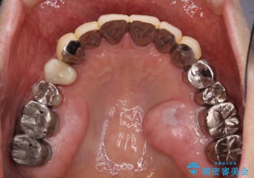 小臼歯の審美治療 ストローマンインプラントとカスタムアバットメントの治療前