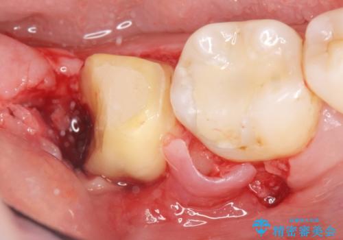 奥歯に違和感がある 30代男性の治療中