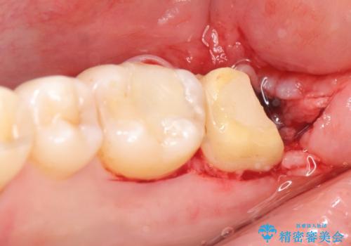 奥歯に違和感がある 30代男性の治療中