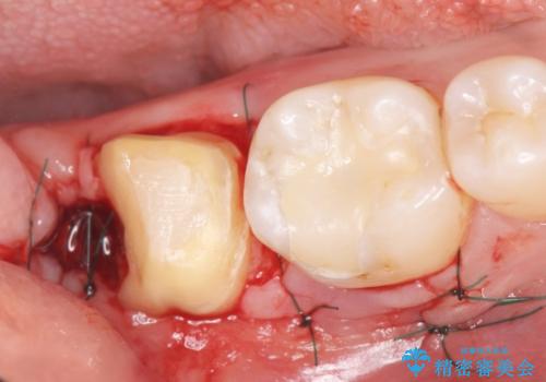 奥歯に違和感がある 30代男性の治療中