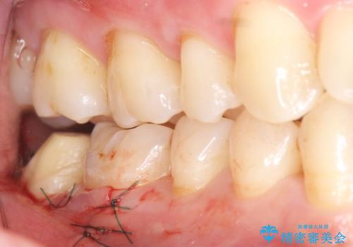 奥歯に違和感がある 30代男性の治療中