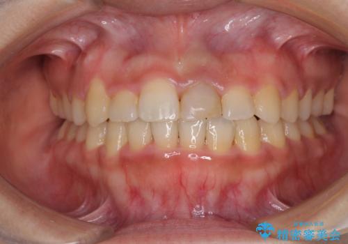 前歯の反対咬合　非抜歯のワイヤー矯正の症例 治療後