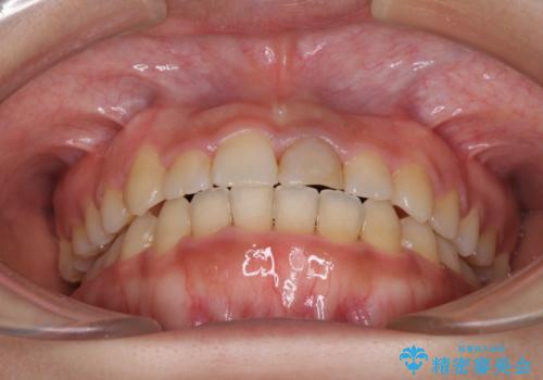 前歯の反対咬合 非抜歯のワイヤー矯正の治療後