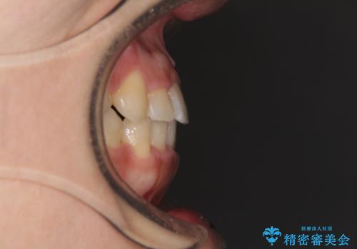 前歯の反対咬合 非抜歯のワイヤー矯正の治療後