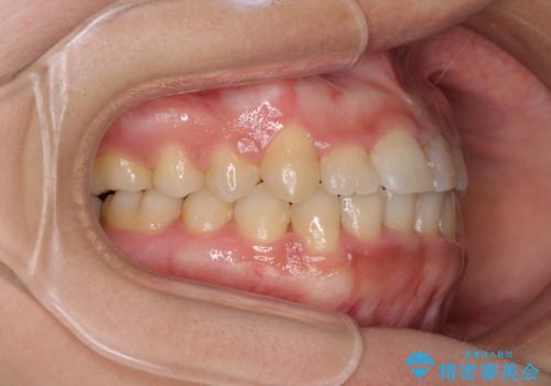 前歯の反対咬合 非抜歯のワイヤー矯正の治療後