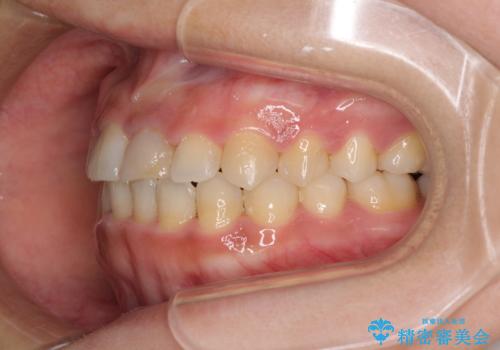 前歯の反対咬合　非抜歯のワイヤー矯正の治療後