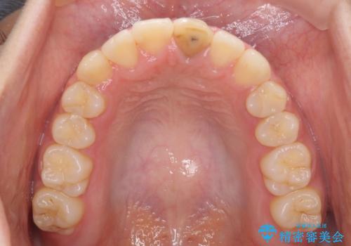 前歯の反対咬合 非抜歯のワイヤー矯正の治療後