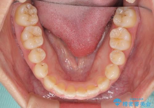 前歯の反対咬合　非抜歯のワイヤー矯正の治療後