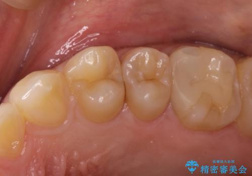 精密なむし歯の治療 セラミックインレーの治療前