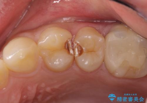 精密なむし歯の治療 セラミックインレーの治療前