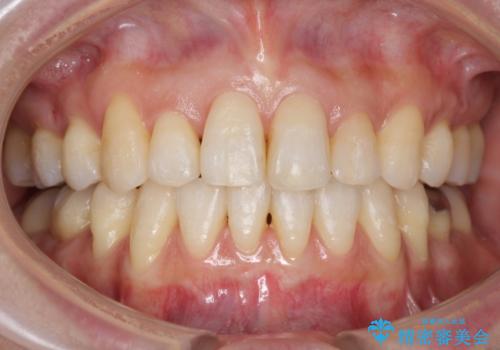 前歯で引っ込んでいる歯がある 他院で矯正200万と言われたの治療後