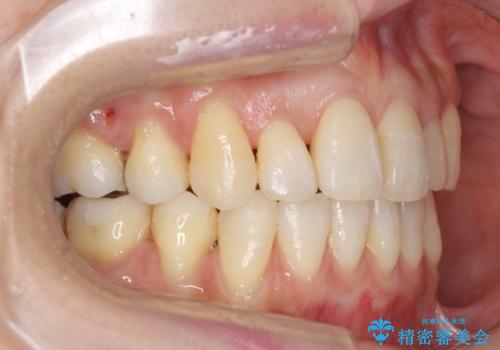 前歯で引っ込んでいる歯がある 他院で矯正200万と言われたの治療後