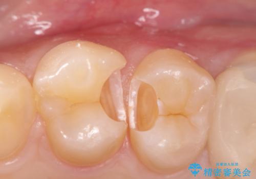 精密なむし歯の治療 セラミックインレーの治療後