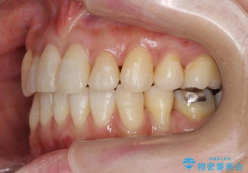 前歯で引っ込んでいる歯がある　他院で矯正200万と言われたの治療後