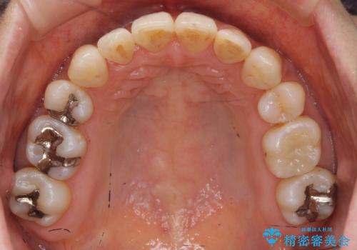 前歯で引っ込んでいる歯がある 他院で矯正200万と言われたの治療後