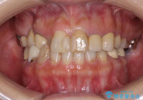 セラミックと矯正を併用してきれいな前歯への治療前