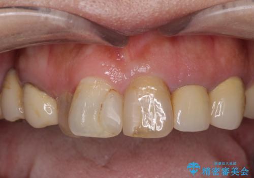 セラミックと矯正を併用してきれいな前歯への治療前