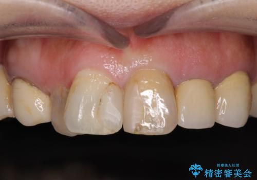 セラミックと矯正を併用してきれいな前歯への治療前