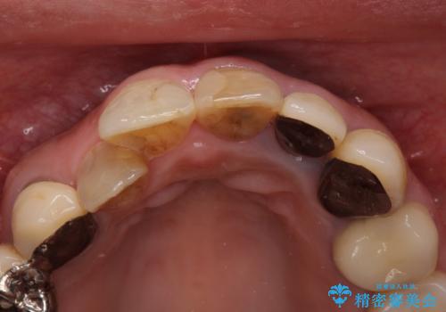 セラミックと矯正を併用してきれいな前歯への治療前