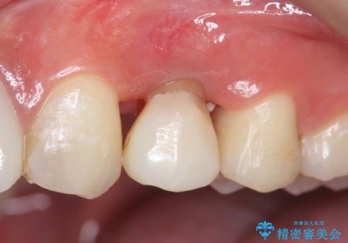 オールセラミッククラウン 歯牙の挺出後の補綴の治療前