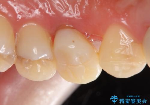 オールセラミッククラウン 歯牙の挺出後の補綴の治療前