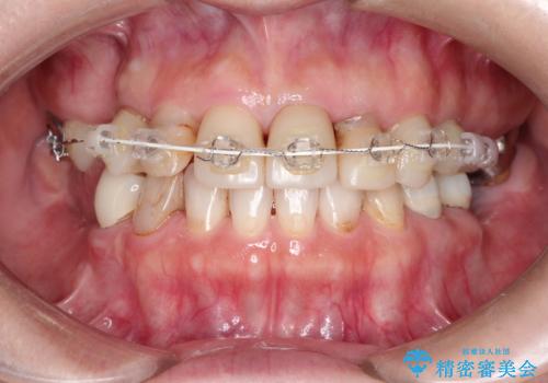 セラミックと矯正を併用してきれいな前歯への治療中