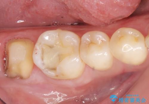 奥歯に違和感がある 30代男性の治療中