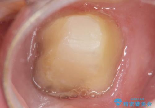 奥歯に違和感がある 30代男性の治療中