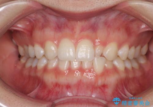 海外転居前に気になる前歯を整えたい　上下前歯の部分矯正の症例 治療前