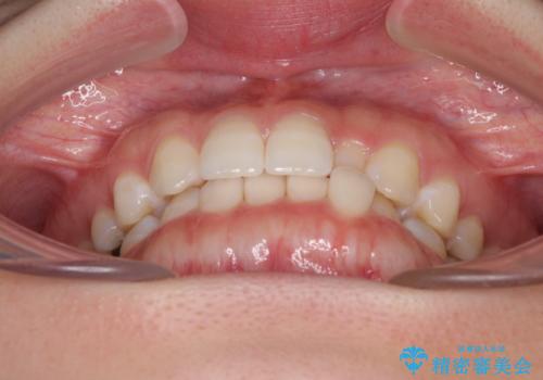 海外転居前に気になる前歯を整えたい 上下前歯の部分矯正の治療前