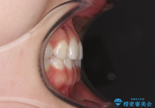 海外転居前に気になる前歯を整えたい 上下前歯の部分矯正の治療前