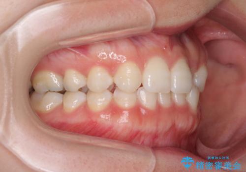 海外転居前に気になる前歯を整えたい 上下前歯の部分矯正の治療前
