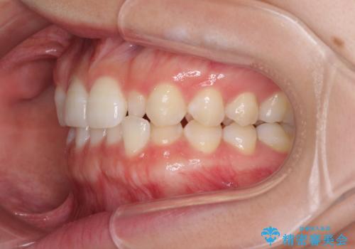 海外転居前に気になる前歯を整えたい 上下前歯の部分矯正の治療前