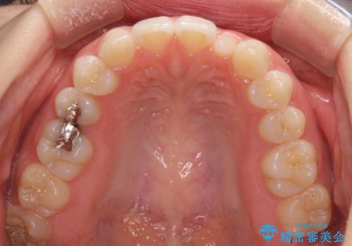 海外転居前に気になる前歯を整えたい 上下前歯の部分矯正の治療前