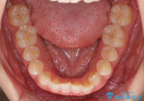 海外転居前に気になる前歯を整えたい 上下前歯の部分矯正の治療前