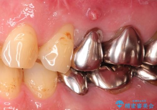 小臼歯部のインプラントの治療前