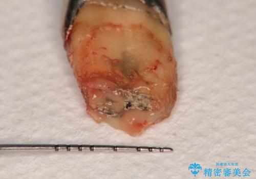 小臼歯部のインプラントの治療前