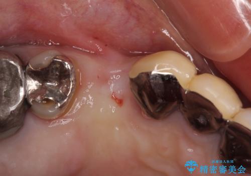 小臼歯の審美治療　ストローマンインプラントとカスタムアバットメントの治療前