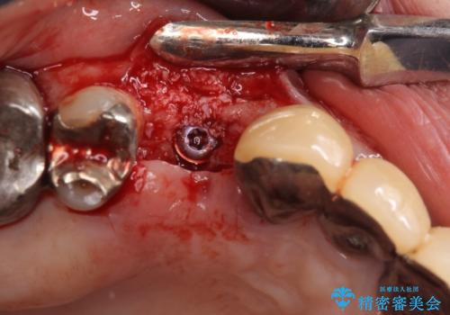 小臼歯の審美治療 ストローマンインプラントとカスタムアバットメントの治療後