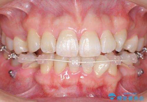 ハーフリンガル　犬歯のねじれ　歯根の外部吸収している歯を抜歯の治療中