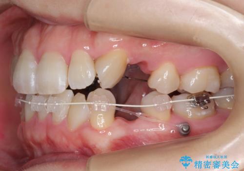 ハーフリンガル　犬歯のねじれ　歯根の外部吸収している歯を抜歯の治療中