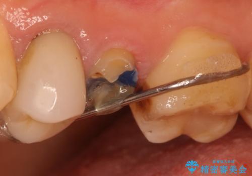 歯肉の中までの深い虫歯 部分矯正後のセラミック治療の治療中