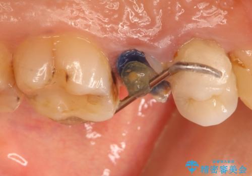 歯肉の中までの深い虫歯 部分矯正後のセラミック治療の治療中